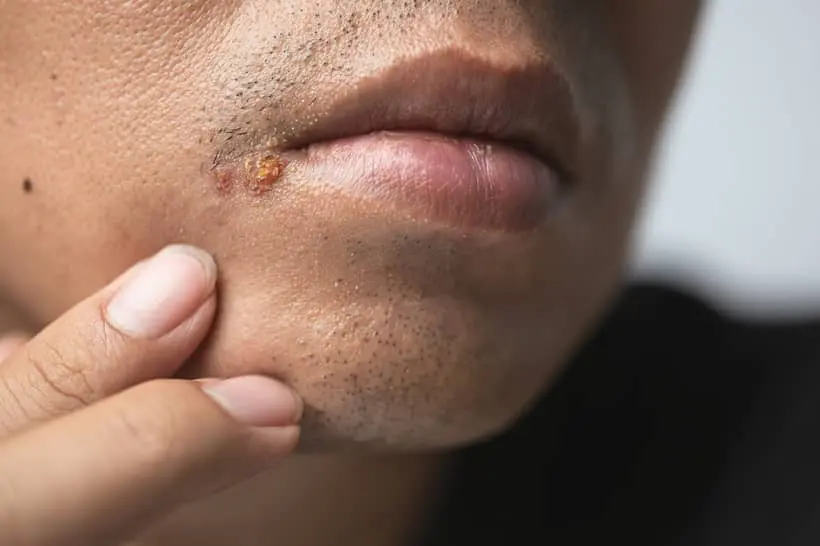 Como o herpes labial pode afetar sua saúde bucal?