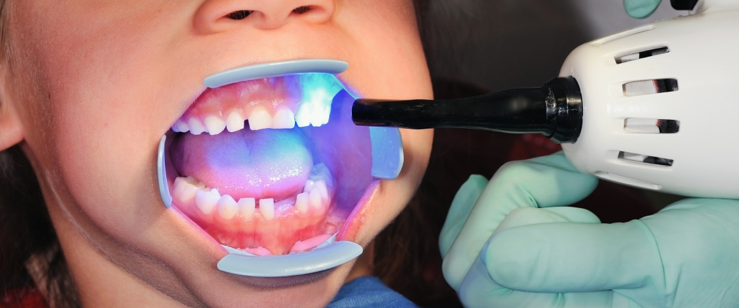 Selante dental para crianças: proteção contra cáries