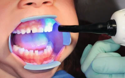 Selante dental para crianças: proteção contra cáries