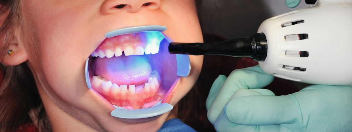 Selante dental para crianças: proteção contra cáries