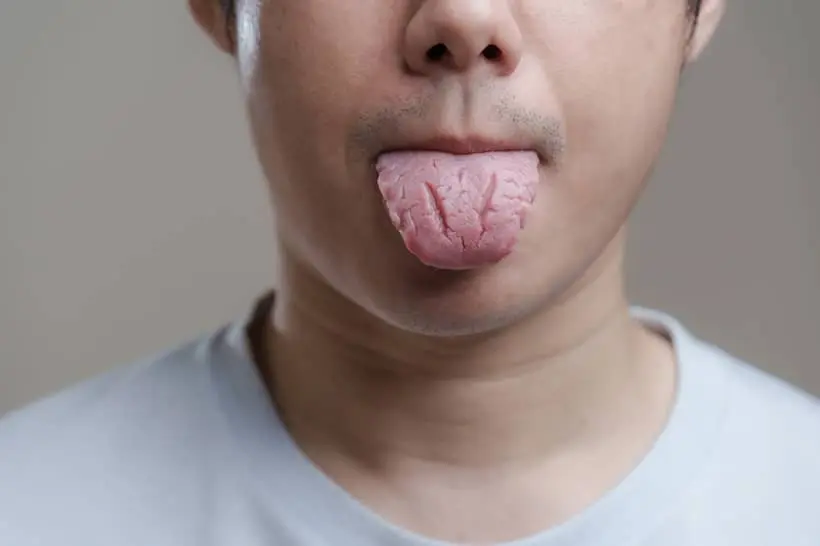 O que causa língua fissurada e quais cuidados tomar?