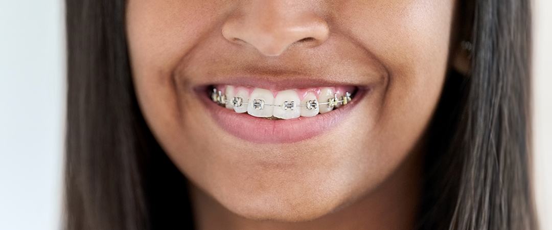 Escova Interdental: O Segredo para um Sorriso Ortodôntico Perfeito