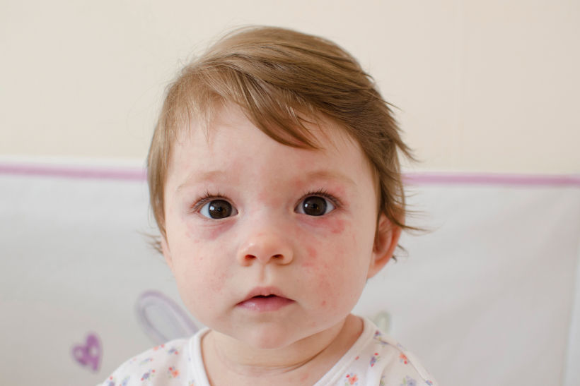 Herpes em bebês: como identificar e tratar corretamente