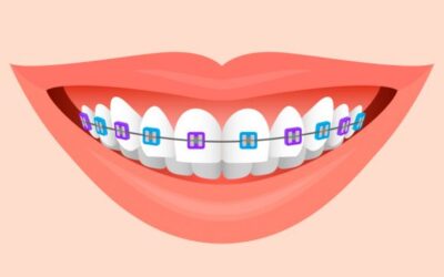 Veja dicas para combinar as cores de borrachinhas do aparelho